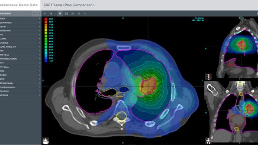 Screenshot of demo lung scan data on ProKnow 