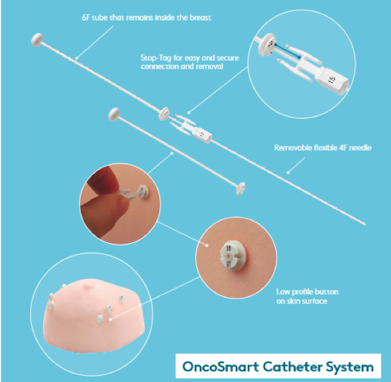 OncoSmart catheter system